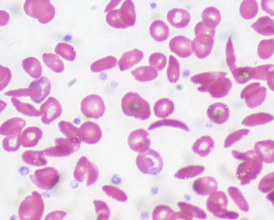Sickle Cell Anemia peripheral blood smear