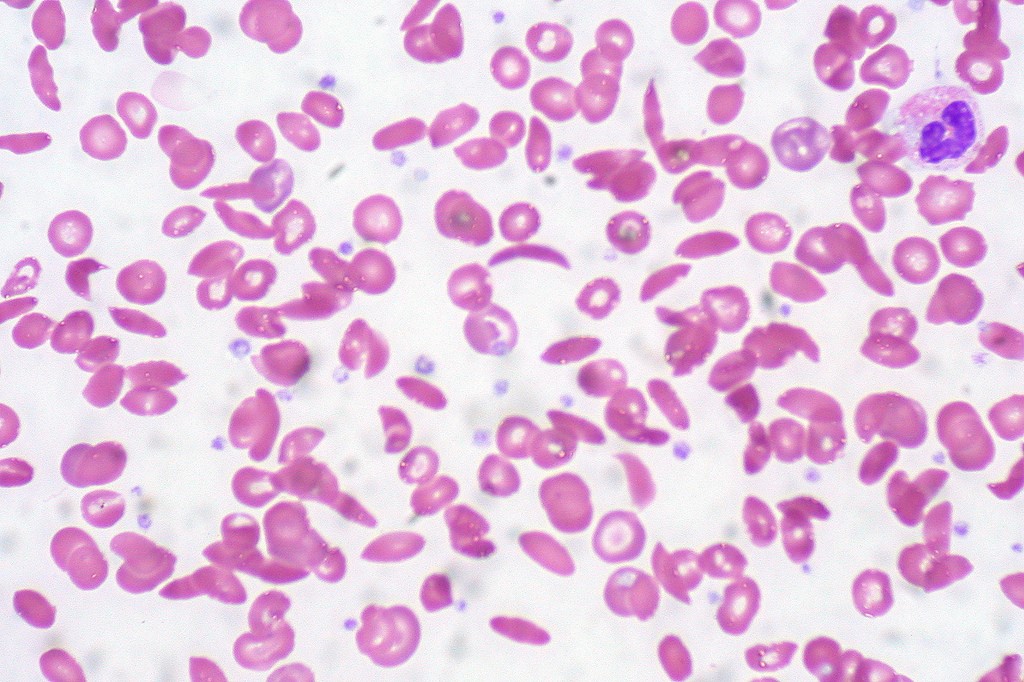 five-interesting-facts-about-sickle-cell-anemia-health-works-collective