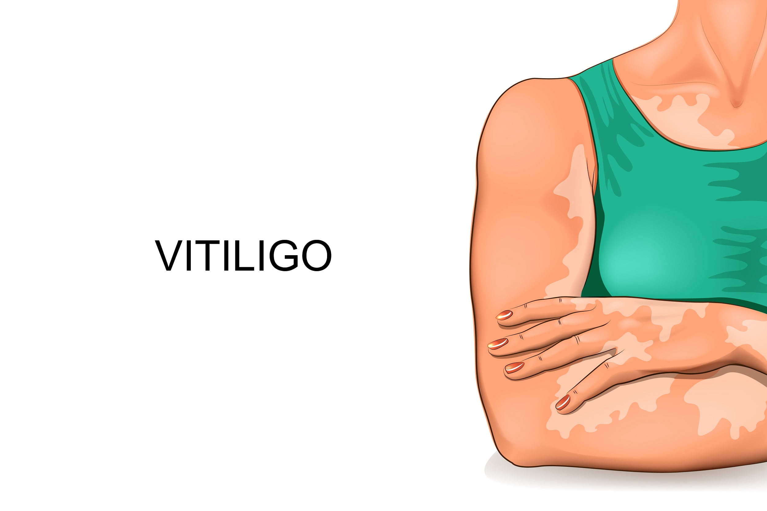 Breakthrough Treatment Gives Vitiligo Patients Hope