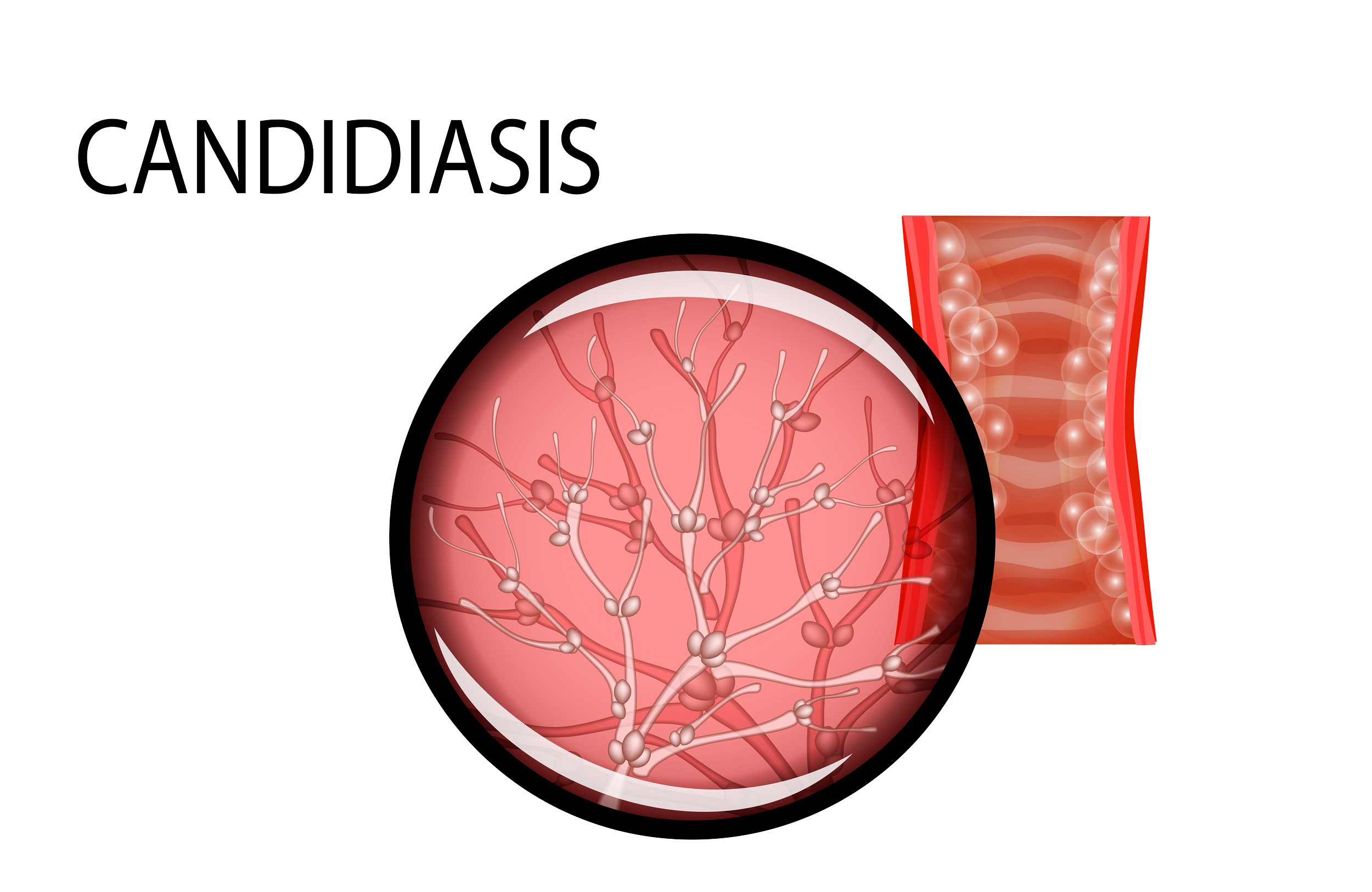 Early Signs And Symptoms Of Candidiasis Infection Health Works Collective 4569