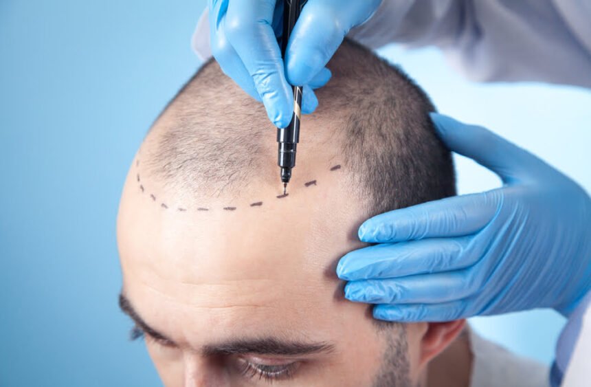 benefits of getting a hair transplant in turkey