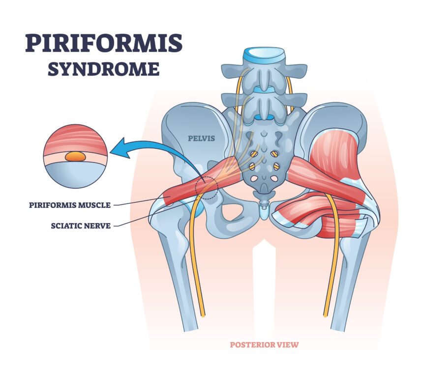 How to Sleep with Piriformis Syndrome - Vive Health