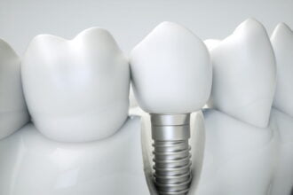 Dental Implant Failure: Possible Causes and Prevention