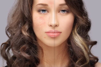 skin pigmentation disorder tips