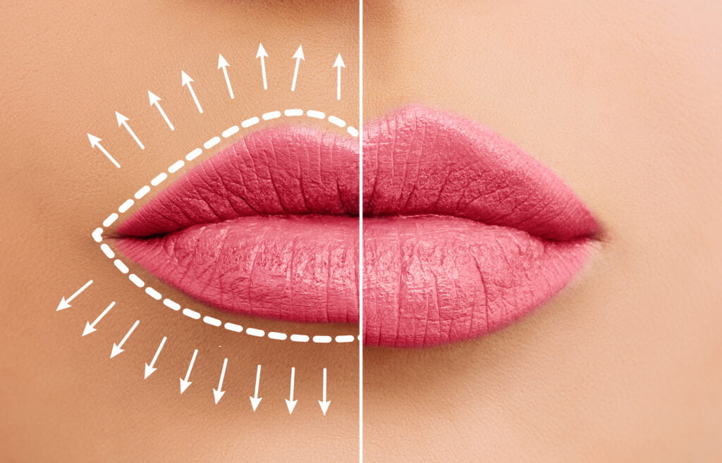 Lip augmentation concept. Woman lips before and after lip filler