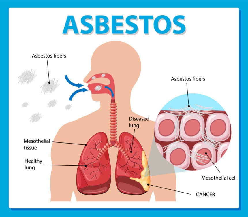 Understanding the Connection Between Asbestos and Mesothelioma